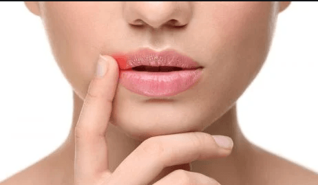 Cause of Lip Outbreaks, Lip Blisters and Cold Sores | Clear Probiotics